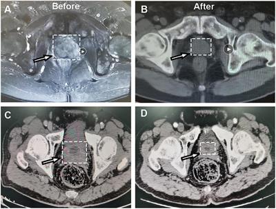 Predictive Biomarkers of Dicycloplatin Resistance or Susceptibility in Prostate Cancer